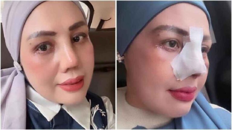 Elly Sugigi Jalani Operasi Plastik Demi Bangkit dari Hinaan, Habiskan Rp65 Juta untuk Hidung dan Mata